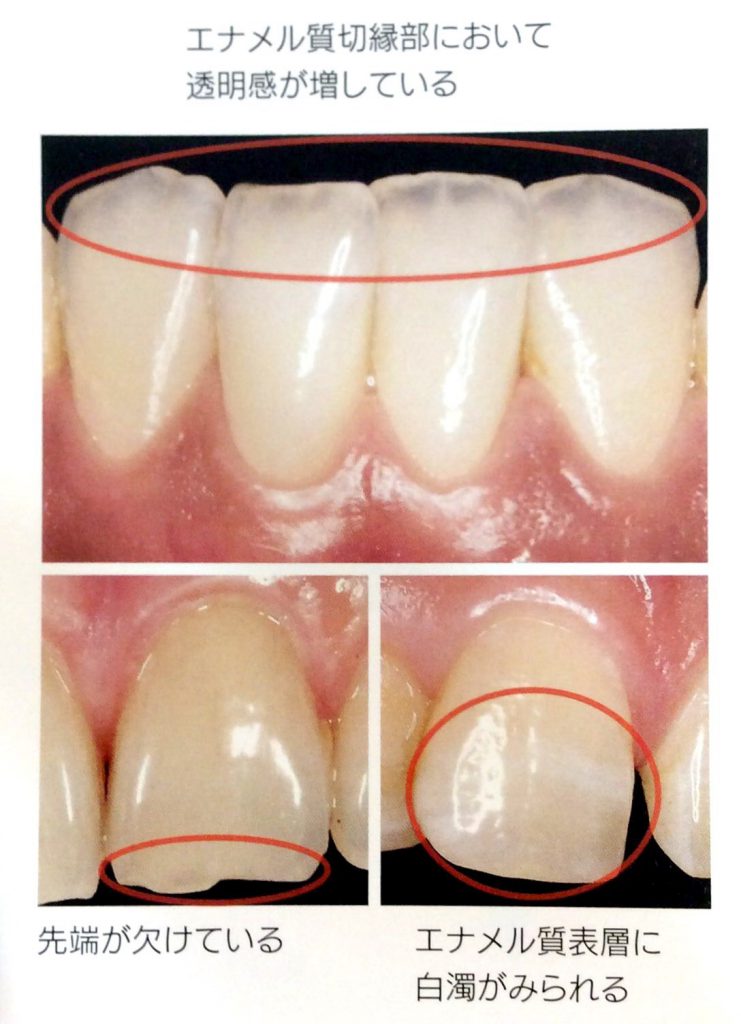 歯の酸蝕は外見も質も悪化させる 飯豊歯科クリニック 南橋本の歯医者さん