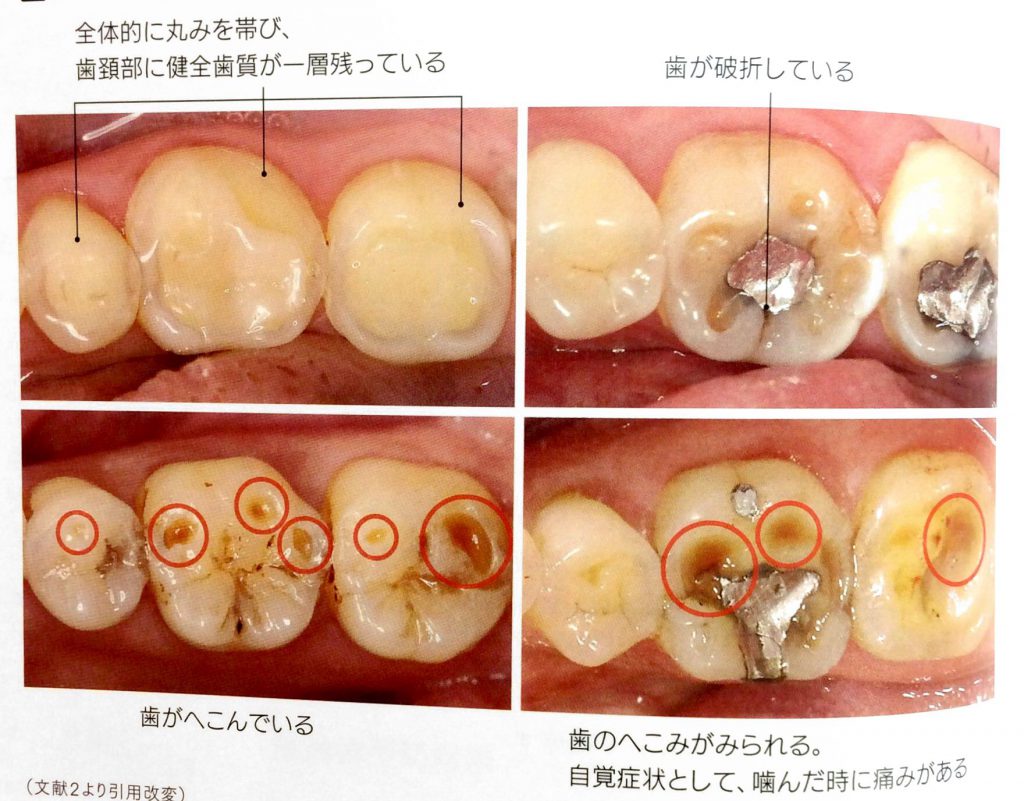 の 匂い 虫歯