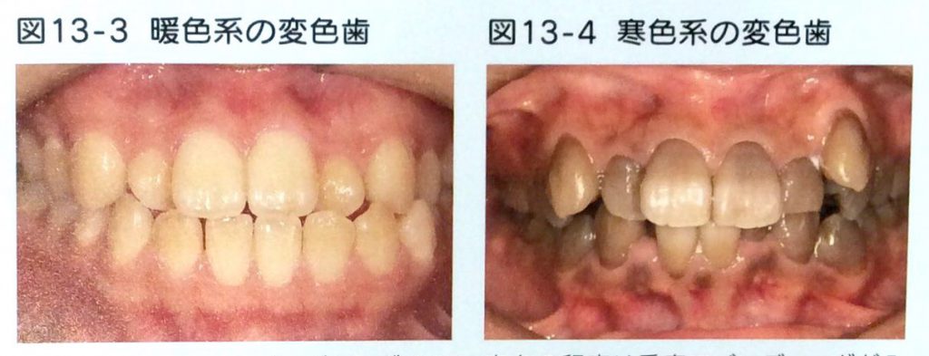 ホワイトニング効果が出やすい歯と出にくい歯があります 飯豊歯科クリニック 南橋本の歯医者さん