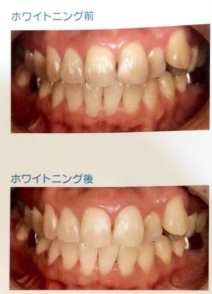 歯 を 白く する 市販